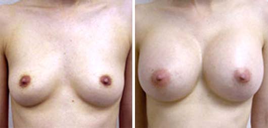 Visual of Fake for Real: Natural Breasts?