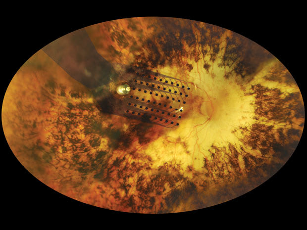 Visual of Bionic Eye: Limited Vision to the Blind