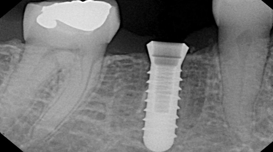 Visual of The Twitter Tooth Implant Becomes a Reality (Again)