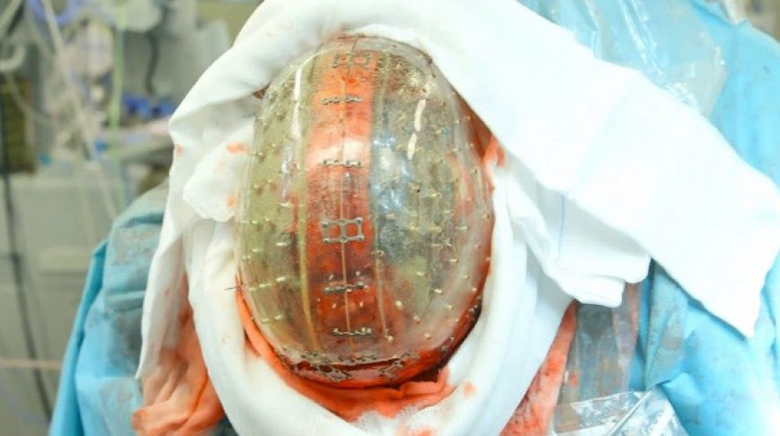 Visual of First 3D-printed Skull implanted